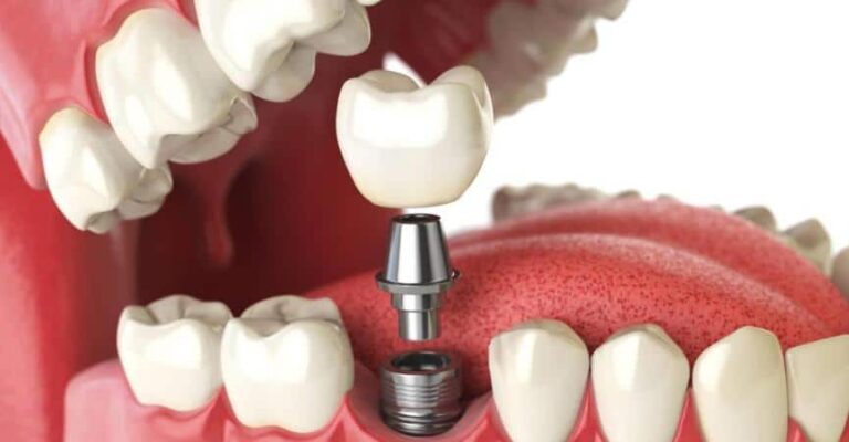 Mini impianti dentari: vantaggi e svantaggi