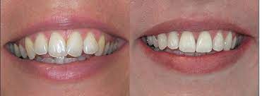 Protesi su impianti: che cosa è l’overdenture?