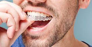 Invisalign: cosa non mangiare e cosa non bere