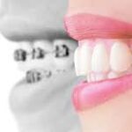 Sopravvivere alla prima settimana con gli allineatori Invisalign