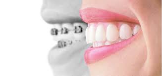 Sopravvivere alla prima settimana con gli allineatori Invisalign