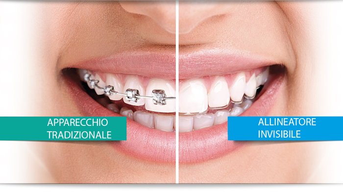 La Guida Definitiva a Invisalign: funziona davvero? In quanto tempo?